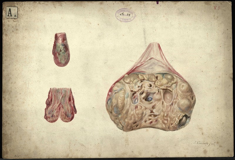 Cystic Disease Of The Testicle Ucd Digital Library 0260