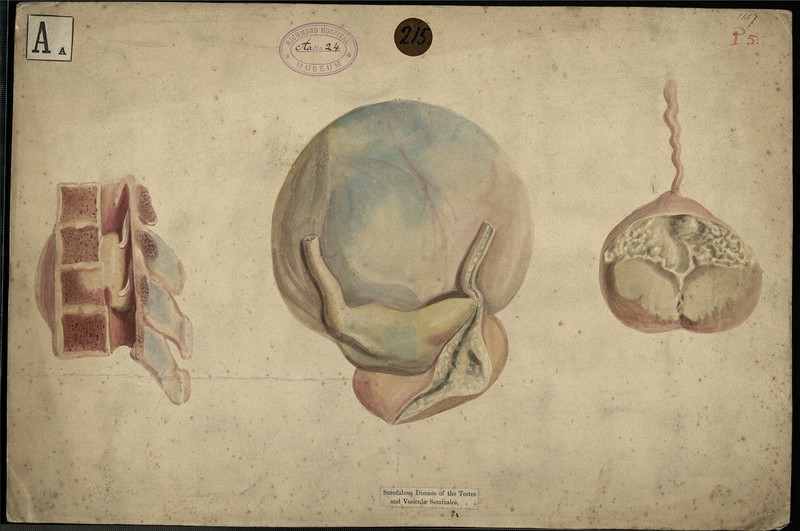 Scrofulous disease of the testes and vesiculae seminales - UCD Digital ...