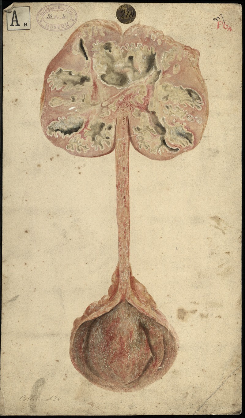 Scrofulous disease of the kidney, ureter & bladder - UCD Digital Library