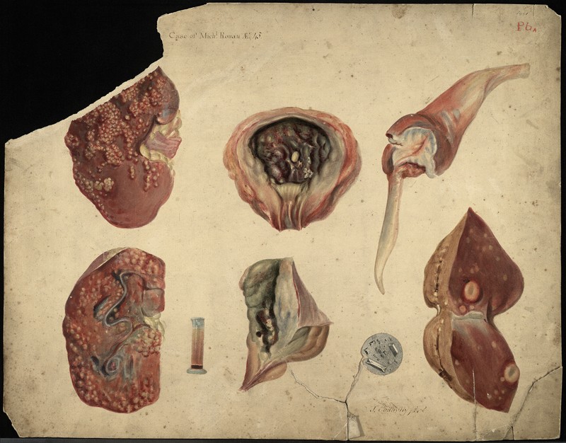 calculus-in-bladder-ucd-digital-library