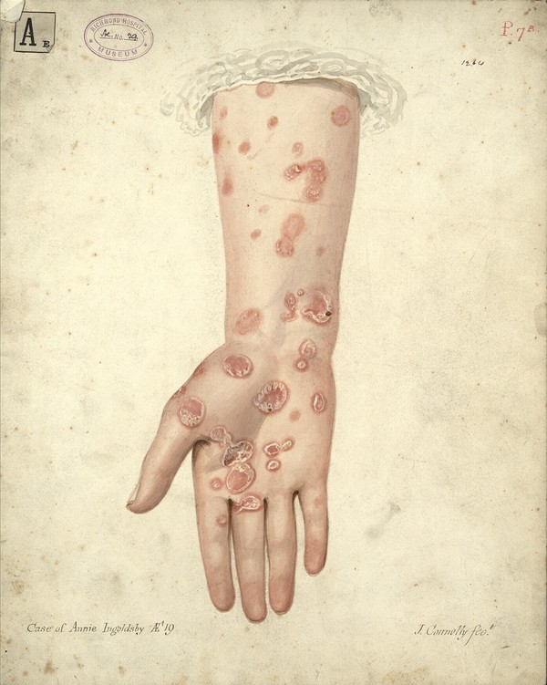 Syphilitic Diseases Ucd Digital Library