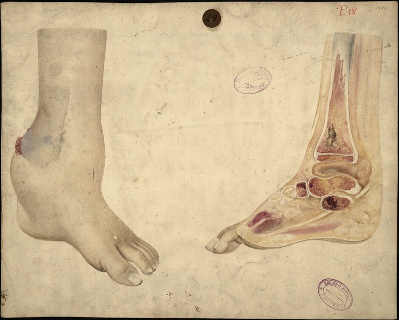 Scrofulous disease of the ankle and tarsus - UCD Digital Library