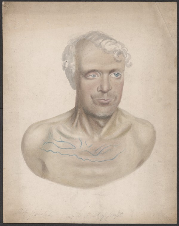 Man With Prominent Blue Veins On His Chest Ucd Digital Library